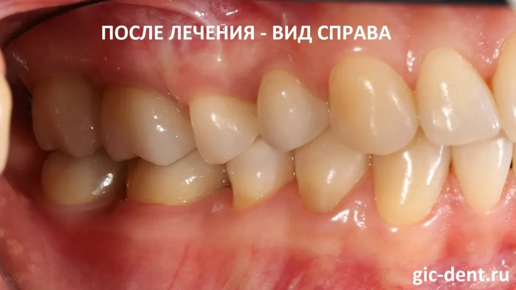 Финишные фото боковой проекции жевательных зубов. Вид справа